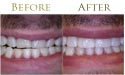 oral teeth whitening before and after