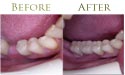 oral tooth whitening before and after